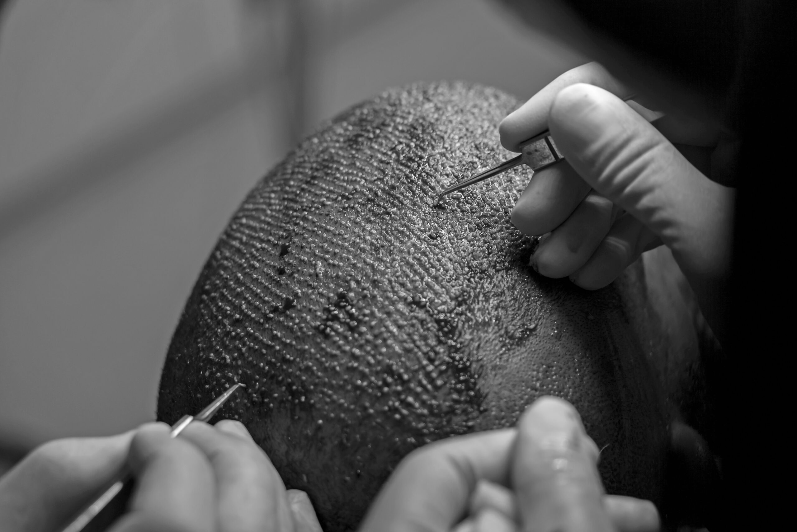 FUE Hair Transplant in Turkey: The Gold Standard for Hair Restoration